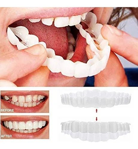 Smile Veneers
