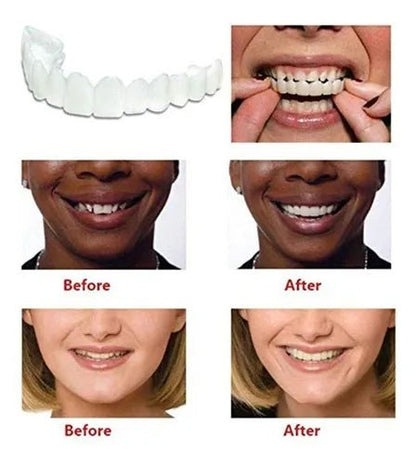 Smile Veneers