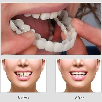 Smile Veneers